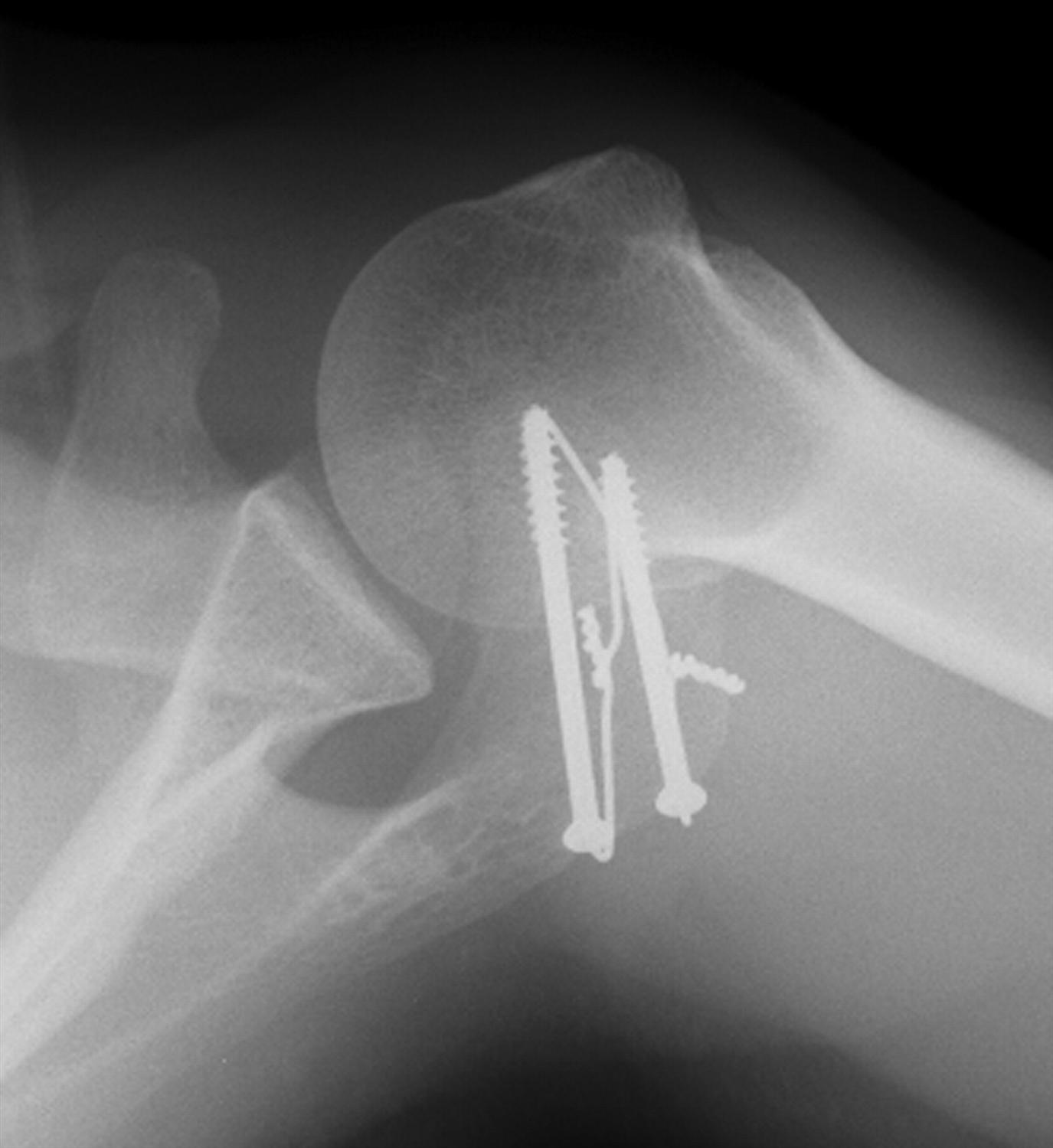 Subacromial Impingement Shoulder & Elbow Orthobullets